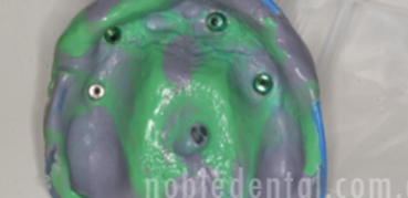 Nobel Procera Implant overdenture