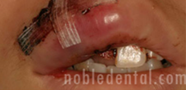 TRAUMA - FRACTURED INCISALLY AND DISTO LABIALLY