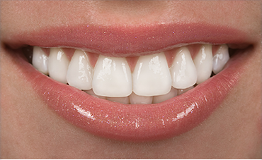 Porcelain Veneers